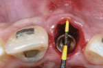 Figure 7 Evaluation of the defect gap after implant placement.