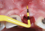 Figure 6 Measurement of the degree of alveolar bone loss by probing the socket walls after extraction.