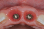 Figure 13 Clinical control showing stabilization of the soft-tissue volume—buccal view (Fig 12) and occlusal view (Fig 13).