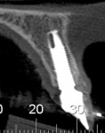 Figure 17 Tomographic view of the maxillary left central incisor after 3 years of follow-up.