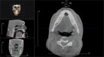 Figure 3 Pre- (Fig 2) and post- (Fig 3) CBCT scans of subject No. 5 showing increase in oropharyngeal. Coronal apical (transverse
slice) is in the same position for both pre- and post-CBCT scans.