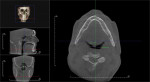 Figure 2 Pre- (Fig 2) and post- (Fig 3) CBCT scans of subject No. 5 showing increase in oropharyngeal. Coronal apical (transverse
slice) is in the same position for both pre- and post-CBCT scans.