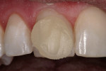 Figure 15  Application of the Light Incisal microfill.