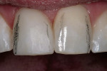 Figure 17  The height of contour was drawn on the central incisors.