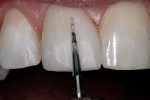 Figure 18  An ET®9 bur was used for the initial contour.