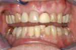 Case 1 pretreatment; the maxillary anterior was the focus for this phase of treatment.