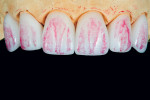 The texture of the teeth was marked on the model in red.