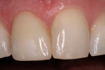 Figure 23  The direct composite veneer at the 6-month recall.
