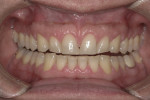 Preoperative retracted view. Note mandibular
plane is worn into a concave pattern.
