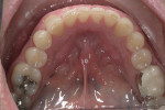 Preoperative mandibular retracted view showing obvious wear into dentin on all mandibular anterior teeth.