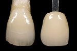 Figure 2  Image of the closest match shade guide next to a natural tooth. This clearly demonstrates that the shade guide is an average of the color zones in a natural tooth.