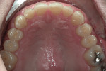 Preoperative maxillary retracted view showing obvious wear into dentin on all maxillary anterior teeth.