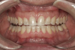 Maxillary and mandibular anterior teeth with the edges restored with composite. This was done in combination equilibration to centric relation.