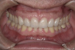 Postoperative retracted frontal. All photographs in this article were reprinted with permission from Dental Arts Laboratories, Inc.