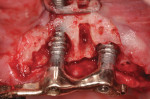 Clinical appearance of decontaminated implants.