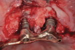 Peri-implantitis lesion.