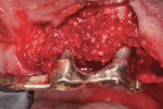 Platelet-rich plasma (PRP)/graft complex placed into the peri-implant defect.