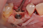 Decontaminated implant surface.