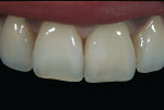 Figure 5a  Image of a single spinell restoration on tooth No. 9, which appears monochromatic and similar to the adjacent natural tooth.