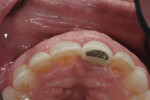 Occlusal view following extrusion.