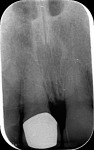 Radiographic view following extrusion and prior to implant placement.