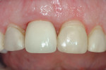 A highly polished, screw-retained provisional was created for the patient.