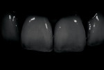 Figure 5b  The same image turned to black and white and darkened, which clearly shows the different value zones in the gingival/incisal areas.