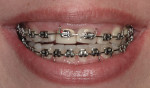 View of the patient in orthodontics after extrusion of tooth No. 8.