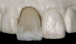 Figure 10a  The built up and fired incisal frame.
