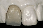 Figure 10b  The built up and fired incisal frame.