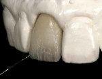 Figure 11  The fired incisal effects.