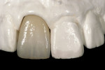 Figure 13  The contoured, glazed, and polished central incisor.