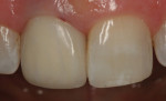 Fig 6. Fig 5. A patient’s crown No. 8, fabricated using ArgenZ Transitionally Shaded Zirconia by Argen Digital. Dentistry performed by Mauricio
Hervas, DDS, MS.