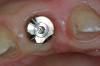Fig 1. (Case 1) Tooth No. 19 manifested a buccal fistulous tract. Probing depth on the buccal was 8 mm.