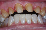 Fig 3. The patient’s natural dentition on the lower anteriors.