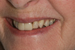 Figure 5 Preoperative photographs showing implant in place of maxillary left central incisor.