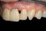 Figure 6 Preoperative photographs showing implant in place of maxillary left central incisor.