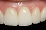 Figure 2 Use of an all-ceramic crown over the abutment to provide excellent esthetics and match adjacent all-ceramic restorations.