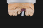 Figure 8 Implant abutment placed on implant analog.