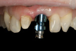 Figure 7 Implant transfer post in place.