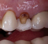 Fig 13. Flap elevated 6 months after d-PTFE barrier and bone graft were placed; the barrier was removed after 4 weeks. This photograph shows the buccal plate regenerated.