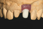 Figure 15 The completed “H” abutment was placed on the implant analog on the master model.