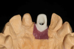 Figure 16 The completed “H” abutment was placed on the implant analog on the master model.