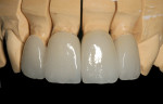 Figure 18 The definitive restorations on the master model.