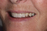 Figure 24 Final restorations 7 months after cementation of the crowns.