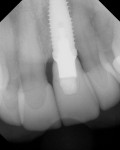 Figure 27. Radiograph of the final restoration
demonstrating absence of subgingival cement/bonding agent.