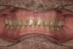 Figure 2 Pre-treatment retracted maximum intercuspation (MIP) showing worn maxillary anterior teeth.