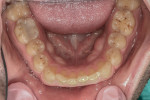 Figure 4 Pre-treatment mandibular arch showing the same wear pattern as the maxillary arch and minimally restored posterior teeth.