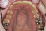 Figure 3 Pre-treatment maxillary arch showing minimally restored posterior teeth with severe wear on anterior teeth.