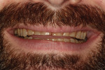 Figure 6 Post-orthodontic full smile showing space available for restorations.